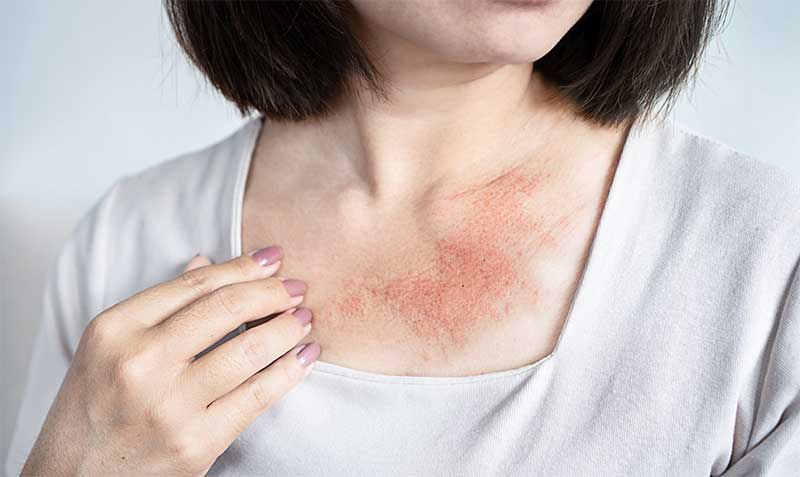 ホメオパシー好転反応の皮膚症状 ホメオパシー皮膚症状